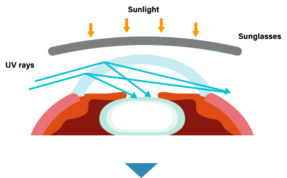 a diagram of uv rays touching your eyes through the gaps on your sunglasses