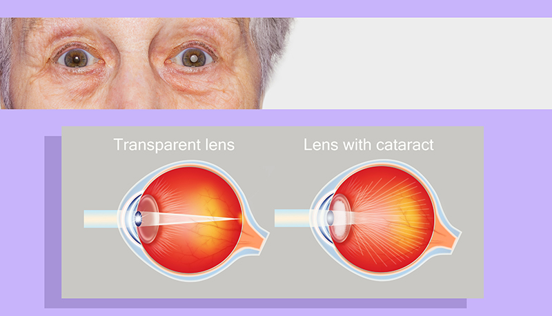 An image of an example of cataract